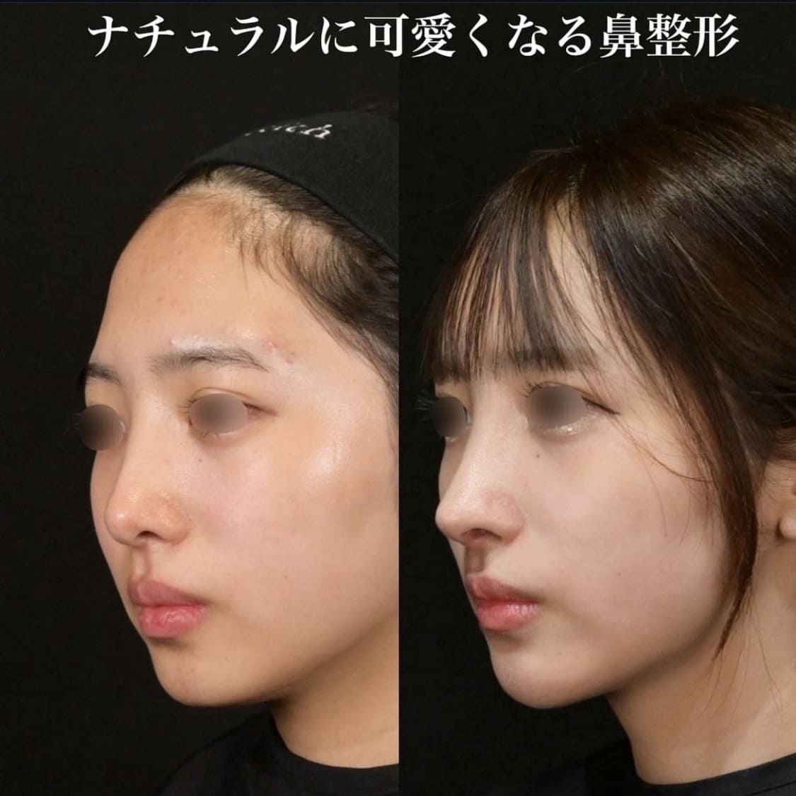 鉄医師による鼻整形の術前/術後６ヶ月 หลัง 