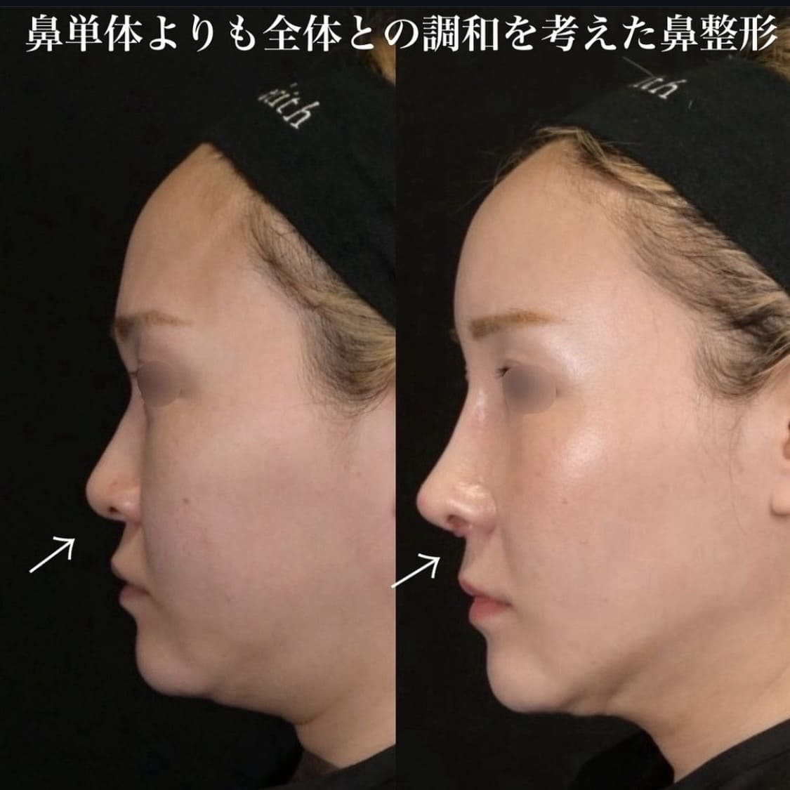 鉄医師による鼻整形の術前/術後２週間 施術後 