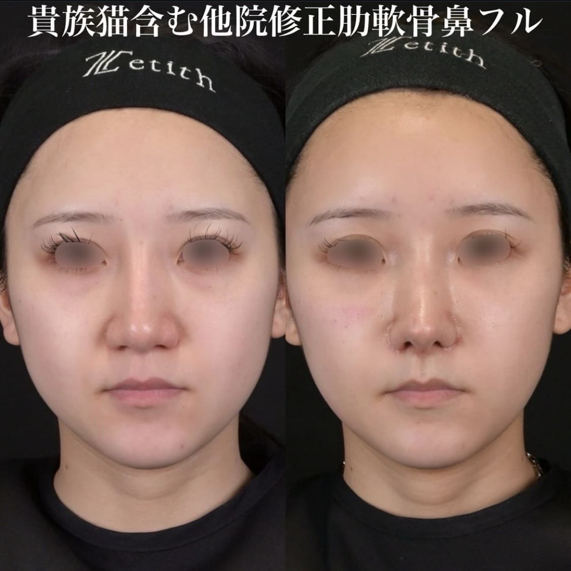 鉄医師による鼻整形の術前/術後２週間