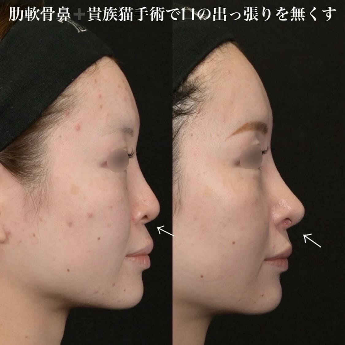 鉄医師による鼻整形の術前/術後6ヶ月 术后 