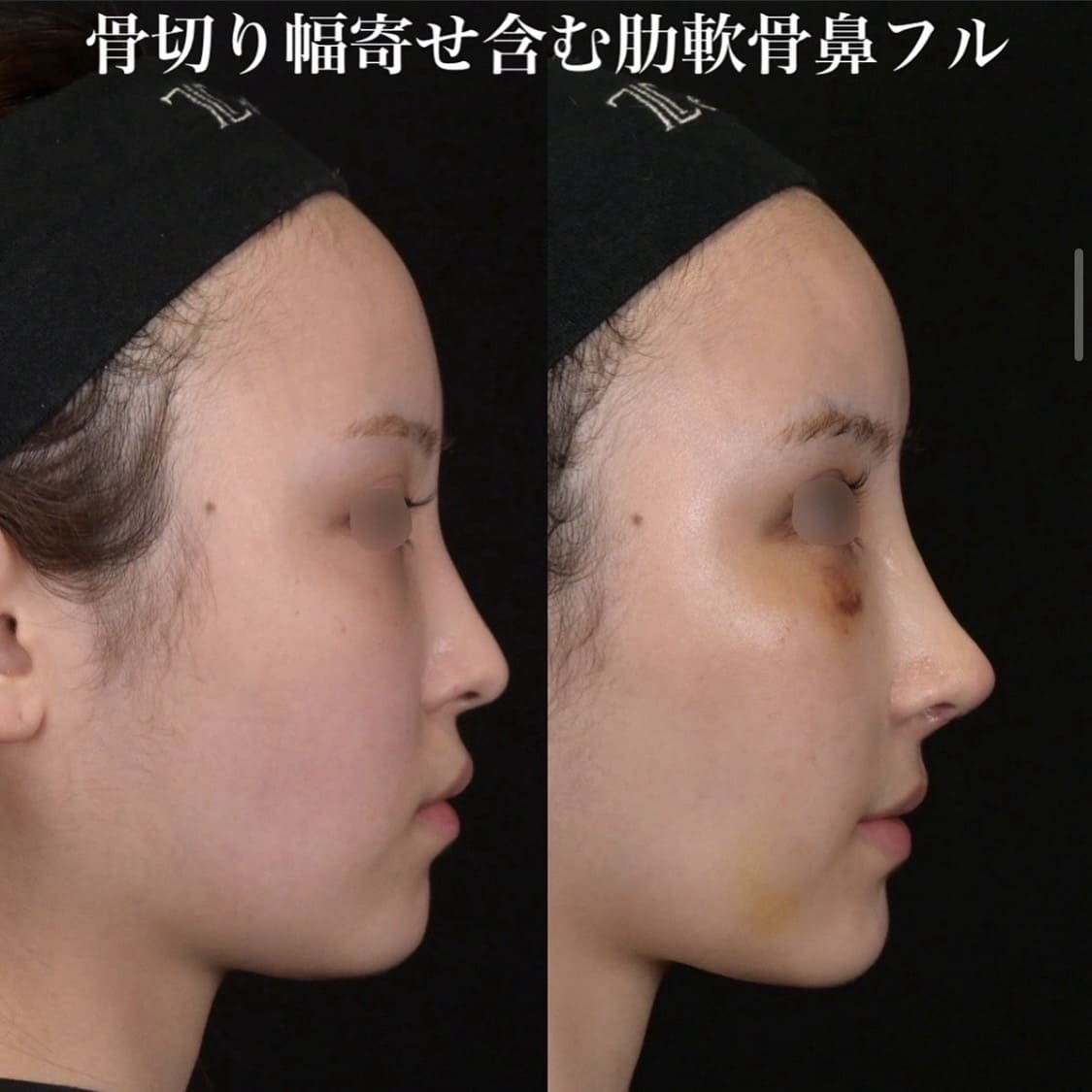 鉄医師による鼻整形の術前/術後２週間 Дараа 