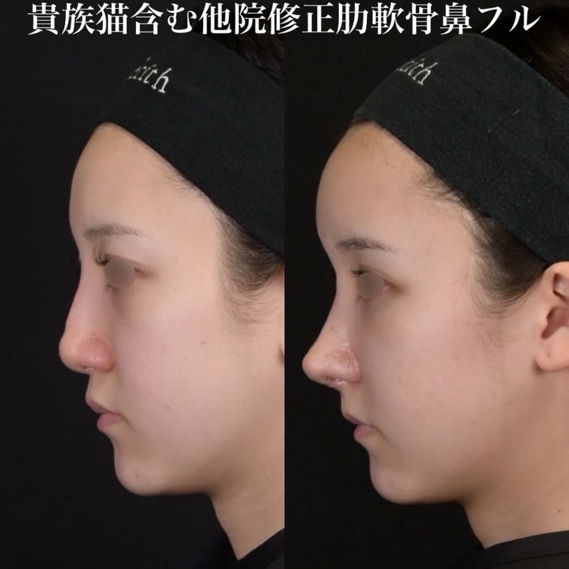 鉄医師による鼻整形の術前/術後２週間 施術後 