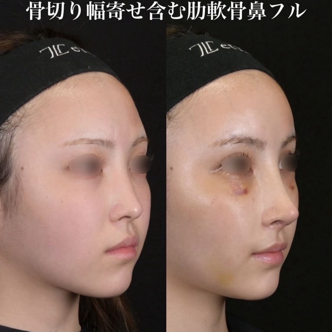 鉄医師による鼻整形の術前/術後２週間