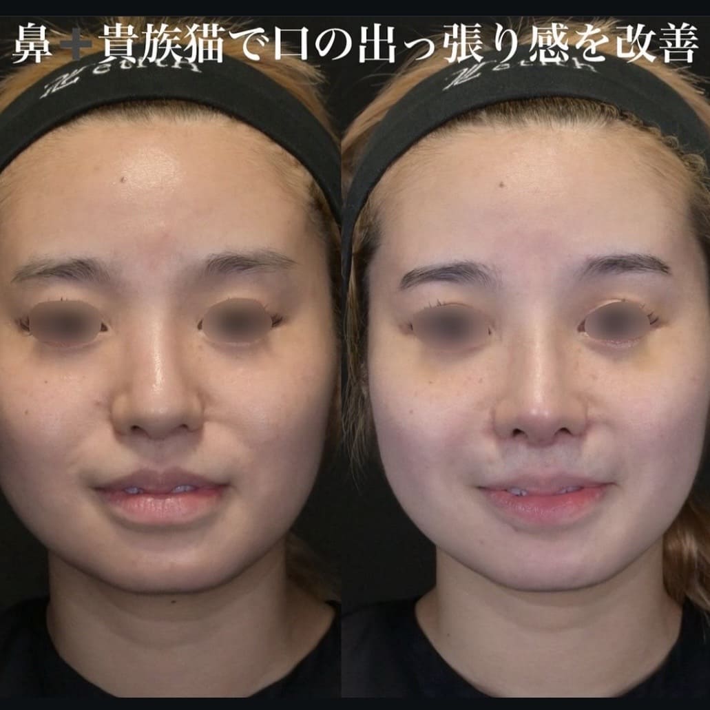 鉄医師による鼻整形の術前/術後２週間