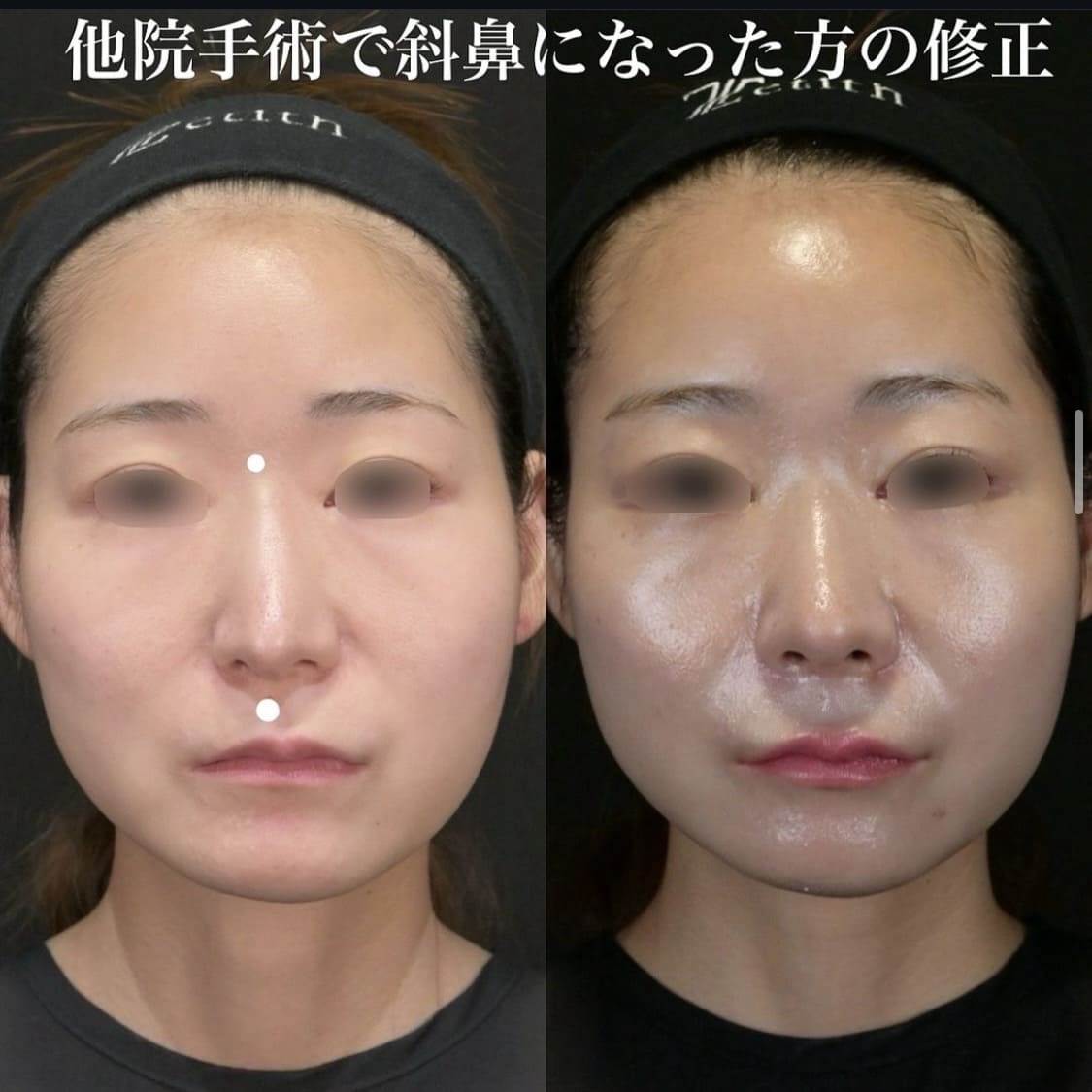 鉄医師による鼻整形の術前/術後１ヶ月
