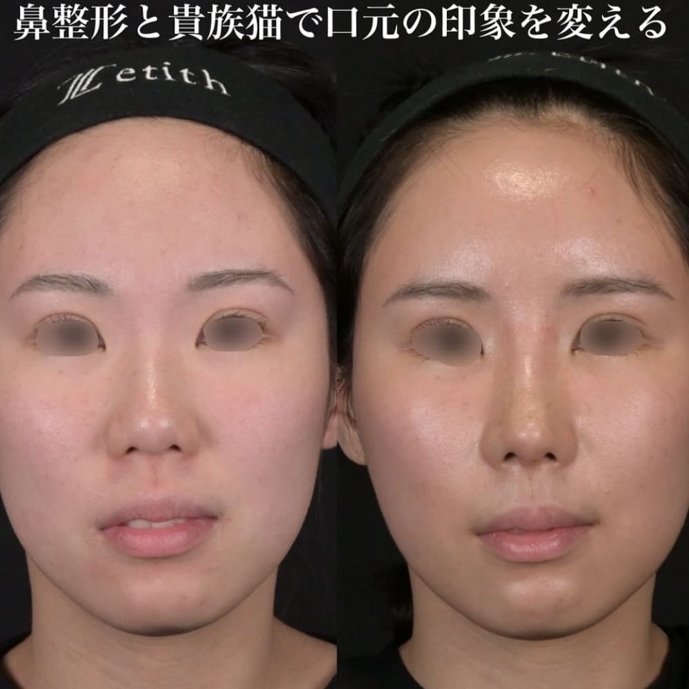 鉄医師による鼻整形の術前/術後２週間