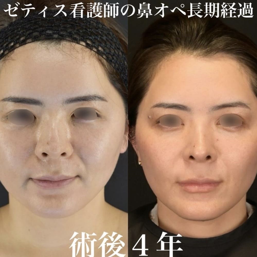 鉄医師による鼻整形の術前/術後4年
