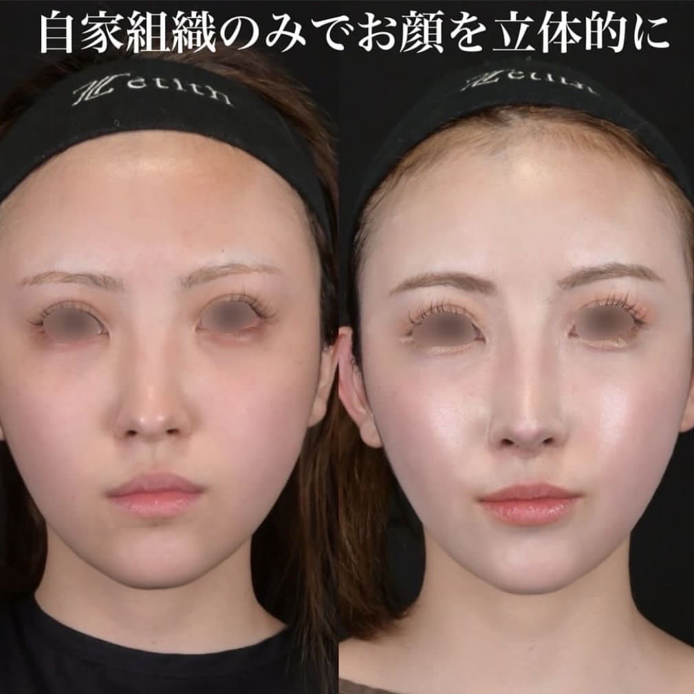 鉄医師による鼻整形の術前/術後1ヶ月