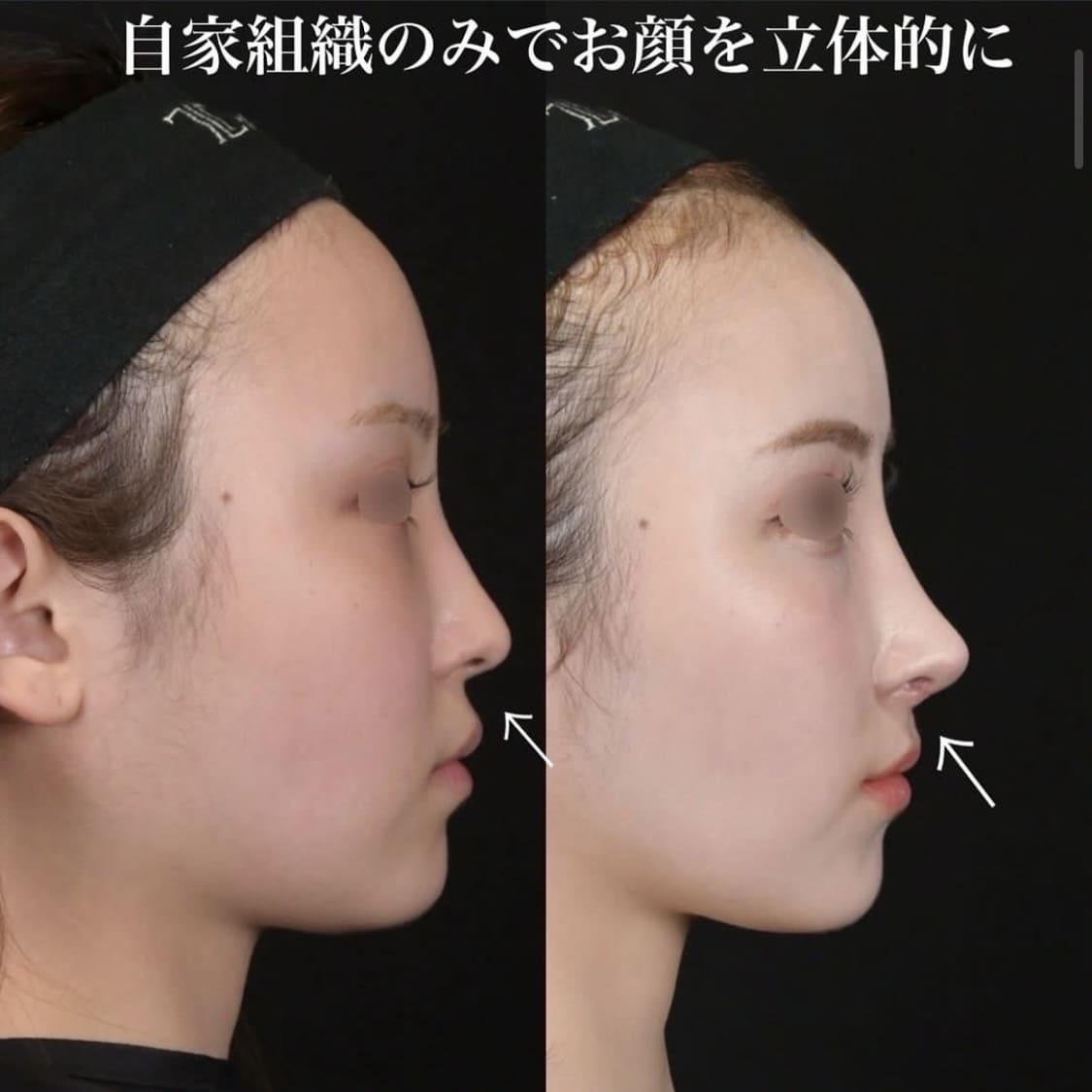 鉄医師による鼻整形の術前/術後1ヶ月 施術後 