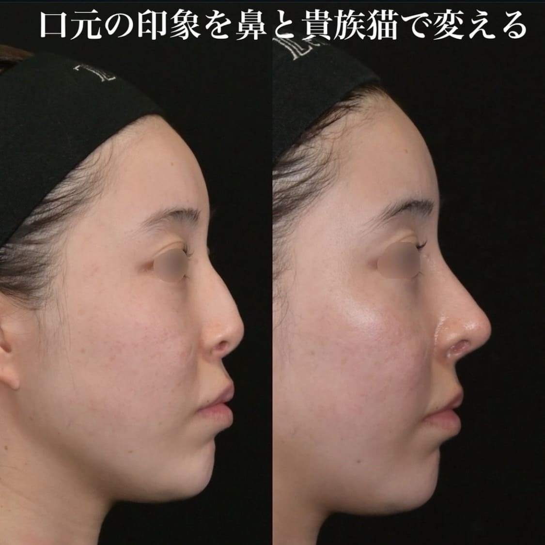 鉄医師による鼻整形の術前/術後１ヶ月 Дараа 
