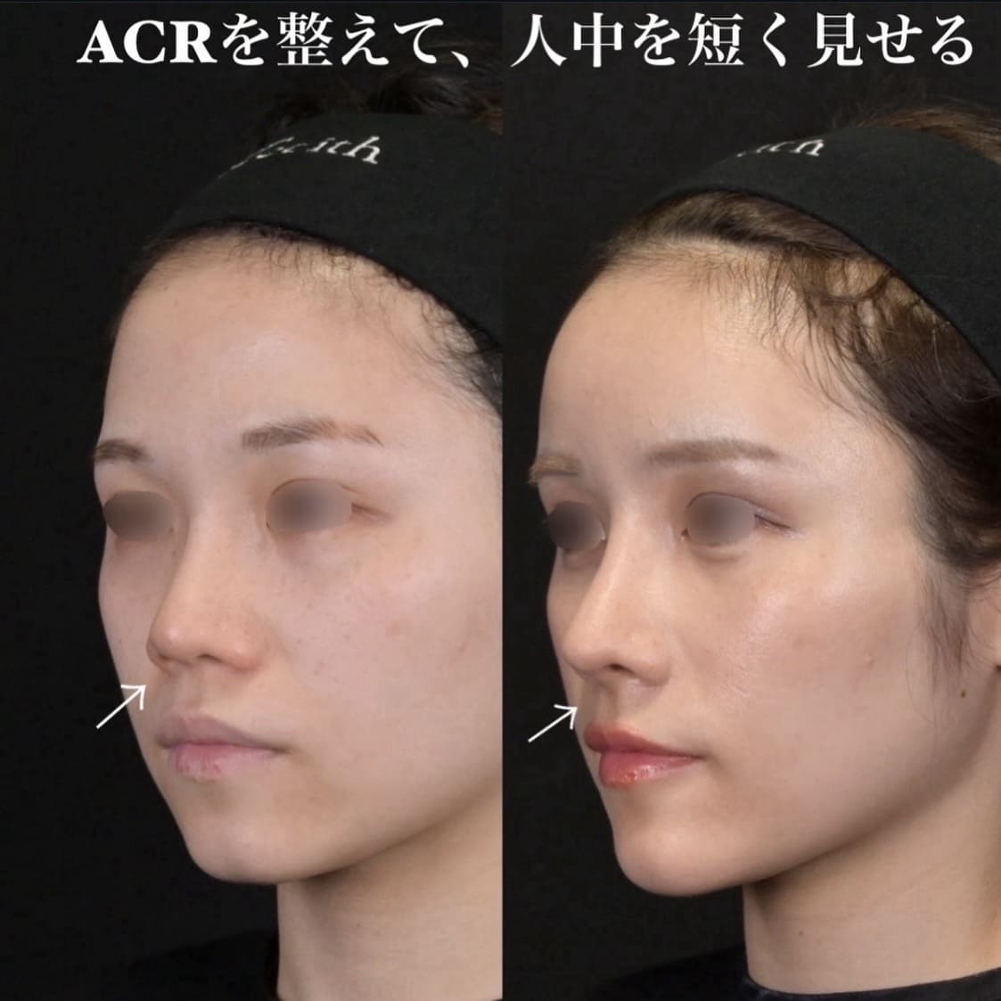 鉄医師による鼻整形の術前/術後１ヶ月 Дараа 