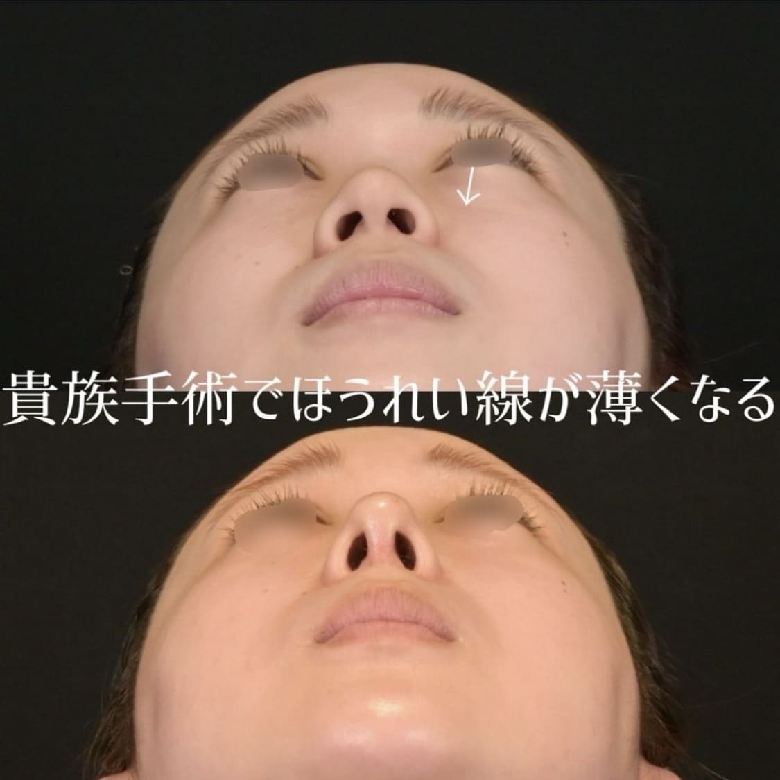 鉄医師による鼻整形の術前/術後6ヶ月 بعد 