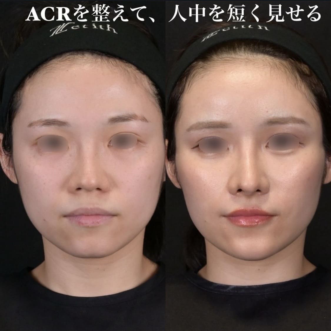 鉄医師による鼻整形の術前/術後１ヶ月