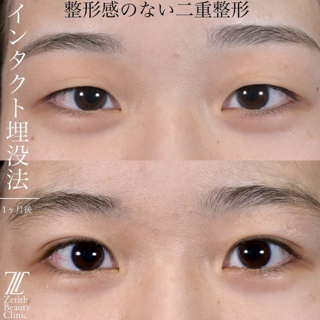 上木原医師による目元整形の術前/術後1ヶ月
