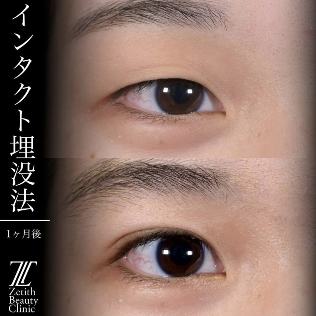 上木原医師による目元整形の術前/術後1ヶ月 Sau 
