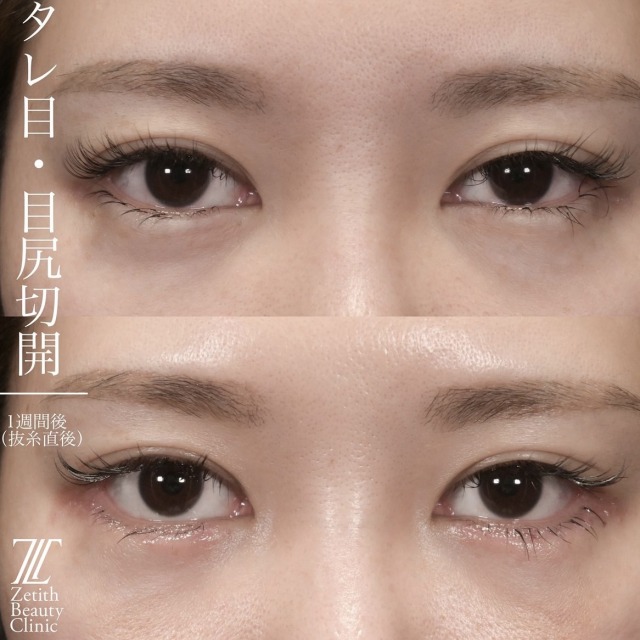 上木原医師による目元整形の術前/術後1週間