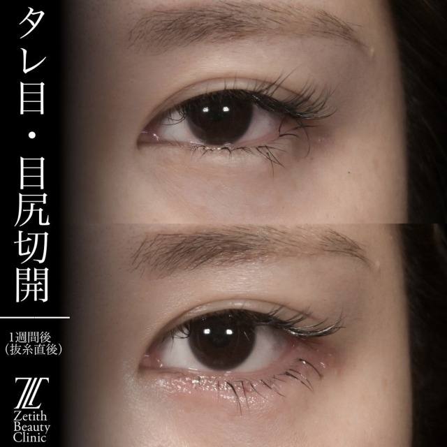 上木原医師による目元整形の術前/術後1週間 After 