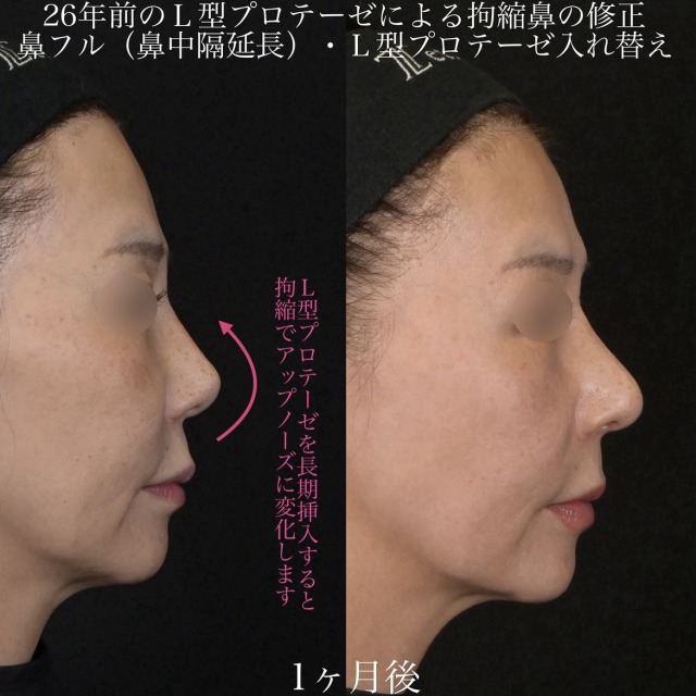 上木原医師による鼻整形の術前/術後1ヶ月