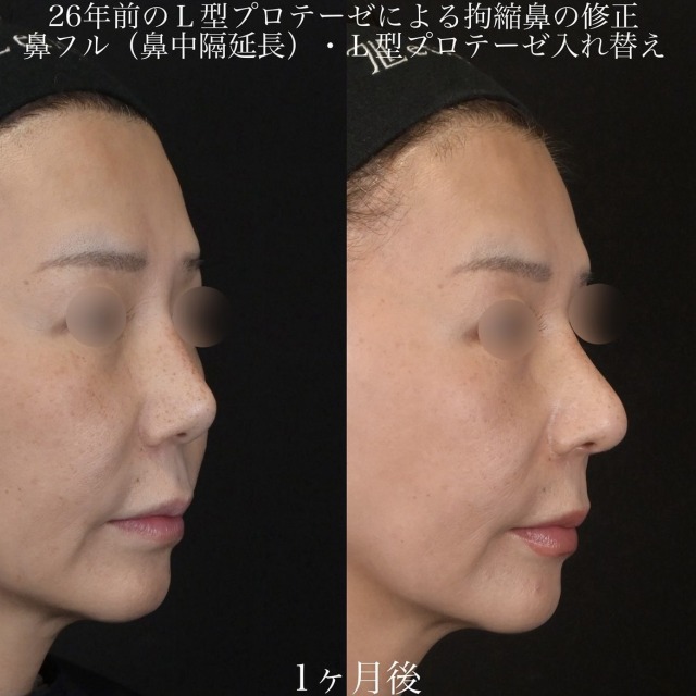 上木原医師による鼻整形の術前/術後1ヶ月 After 