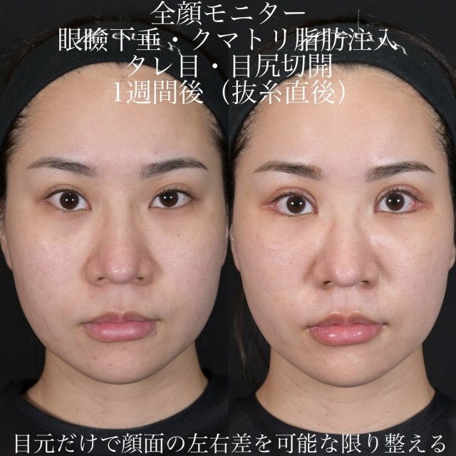 上木原医師による目元整形の術前/術後1週間
