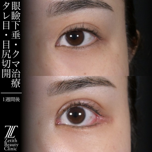 上木原医師による目元整形の術前/術後1週間 Дараа 