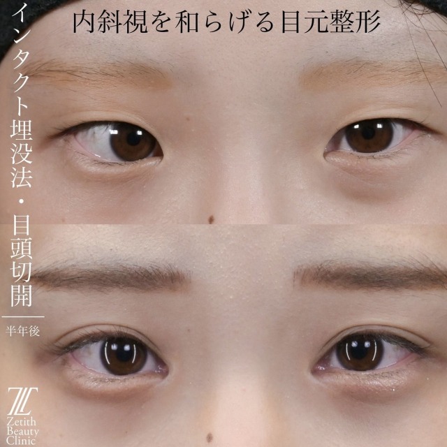 上木原医師による目元整形の術前/術後