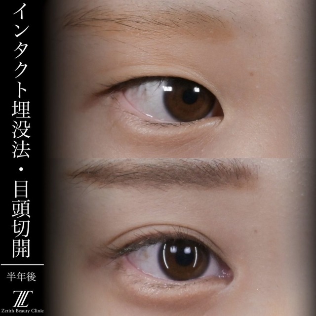 上木原医師による目元整形の術前/術後 术后 