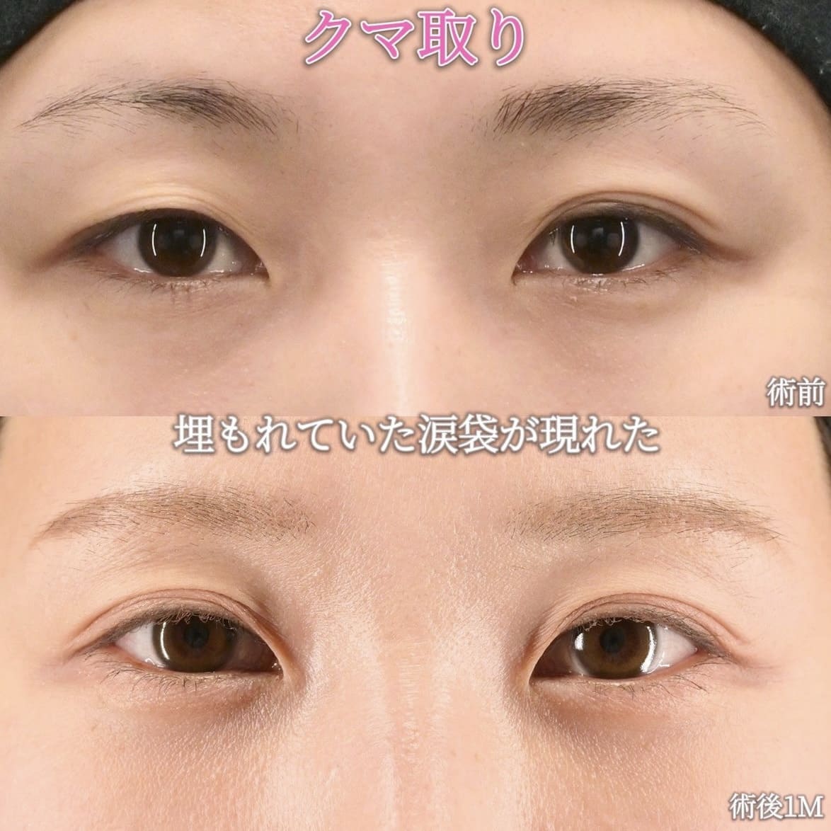 沈医師による目元整形の術前/術後1ヶ月