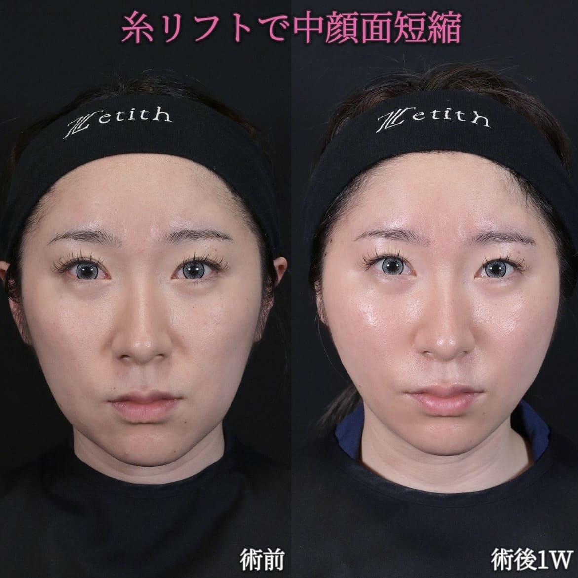 沈医師による糸リフトの術前/術後1週間