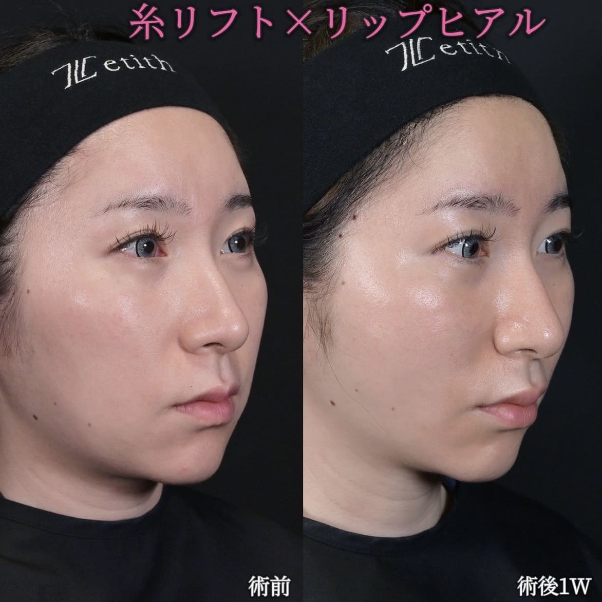 沈医師による糸リフトの術前/術後1週間 施術後 