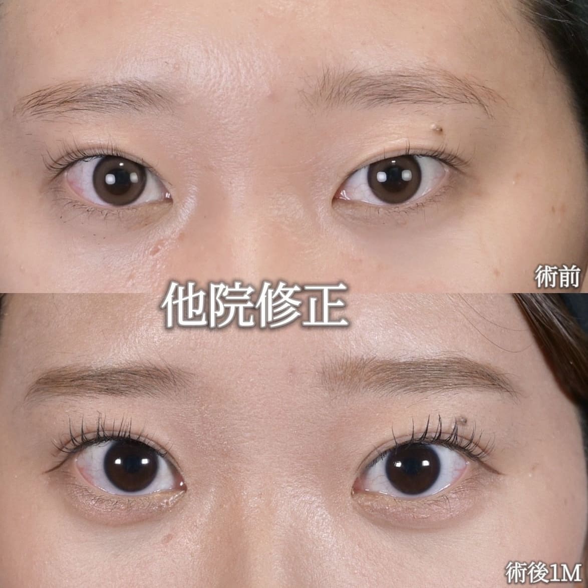 沈医師による目元整形の術前/術後1ヶ月