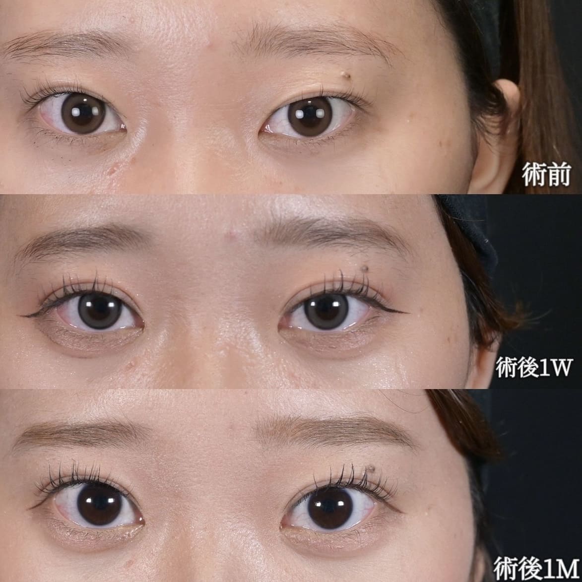 沈医師による目元整形の術前/術後1ヶ月 术后 