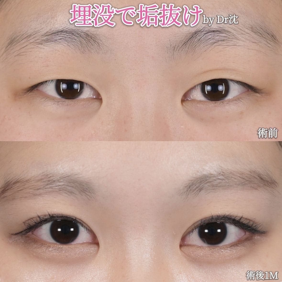 沈医師による目元整形の術前/術後
