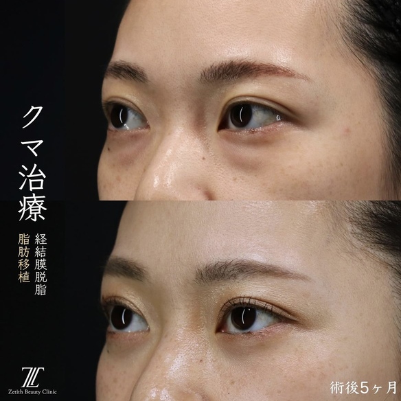 王医師による目元整形の術前/術後5ヶ月 หลัง 