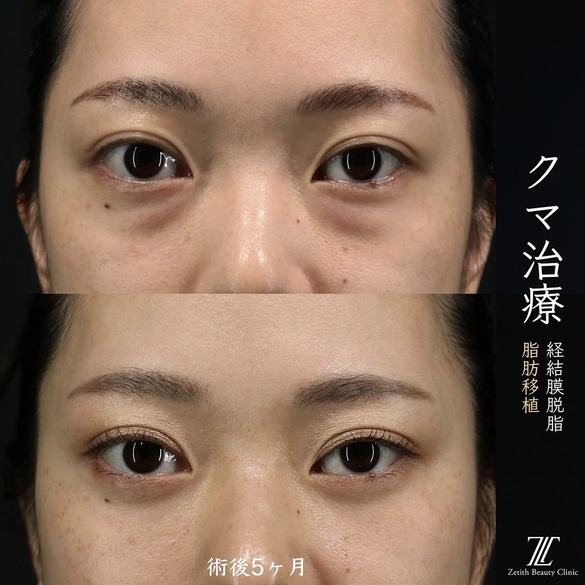 王医師による目元整形の術前/術後5ヶ月
