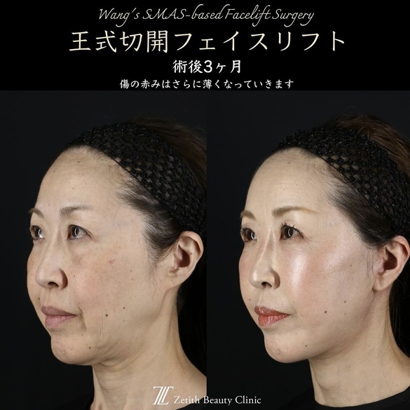 王医師による切開フェイスリフトの術前/術後3ヶ月 Дараа 
