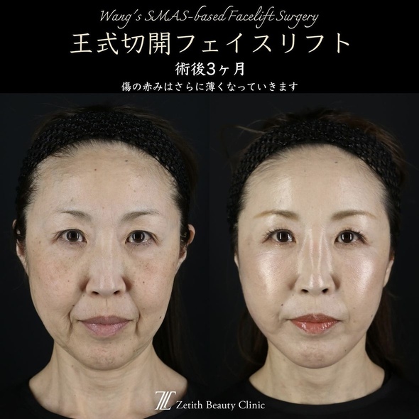 王医師による切開フェイスリフトの術前/術後3ヶ月