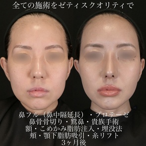 上井木原医師による鼻整形の術前/術後3ヶ月