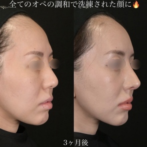 上井木原医師による鼻整形の術前/術後3ヶ月 施術後 