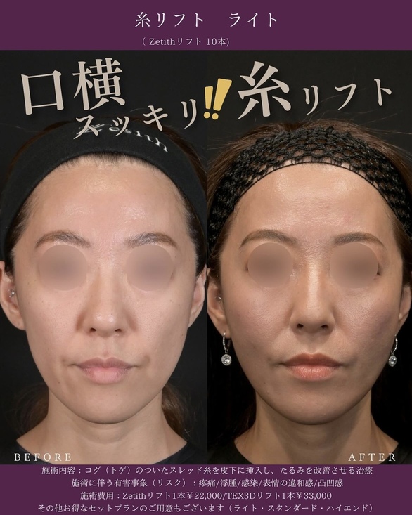 新井医師による糸リフトの術前/術後1週間