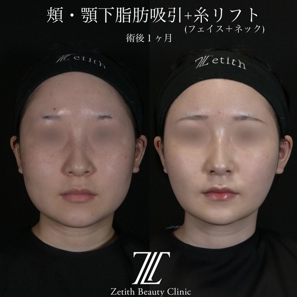 北村医師による脂肪吸引リフトの術前/術後1ヶ月