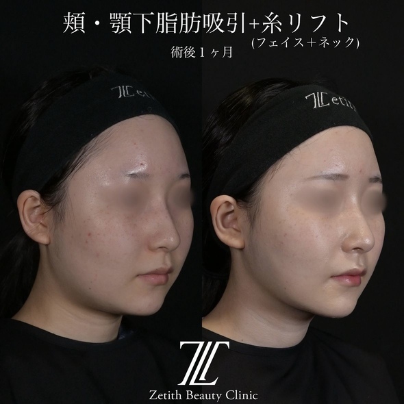 北村医師による脂肪吸引リフトの術前/術後1ヶ月 Sau 