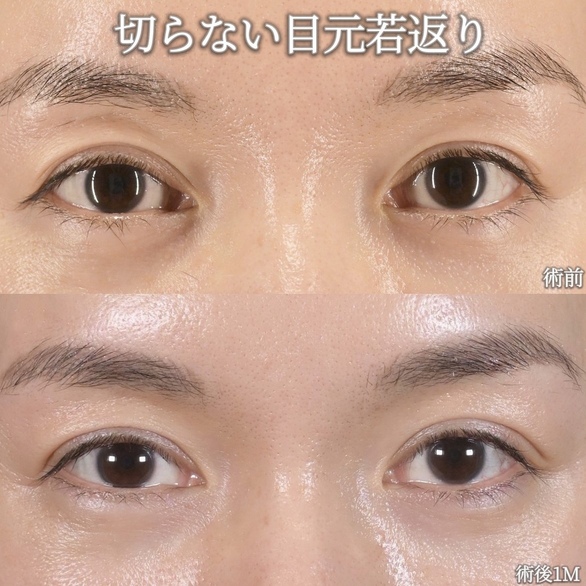 沈医師による目元整形の術前/術後1ヶ月
