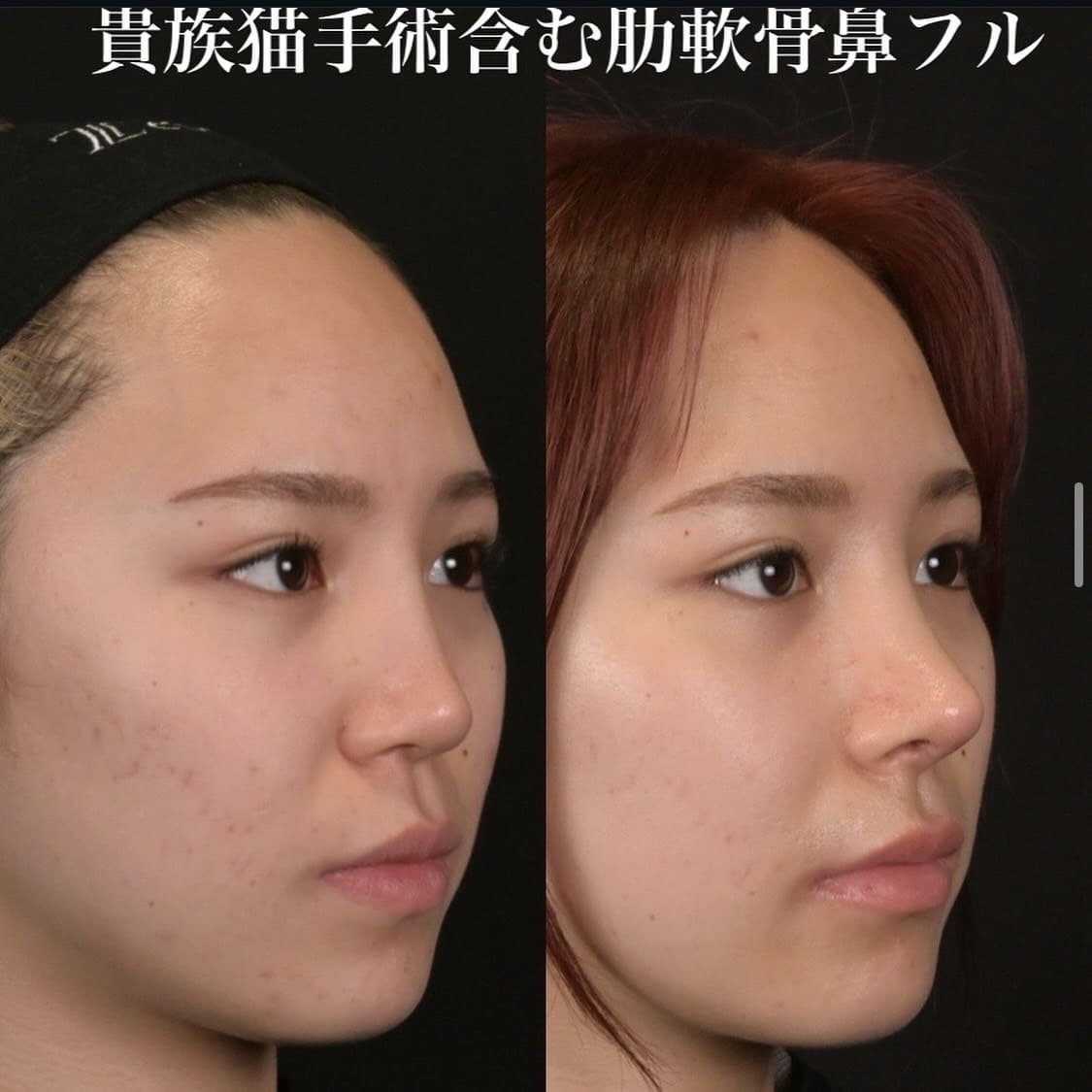 鉄医師による鼻整形の術前/術後1ヶ月 Дараа 