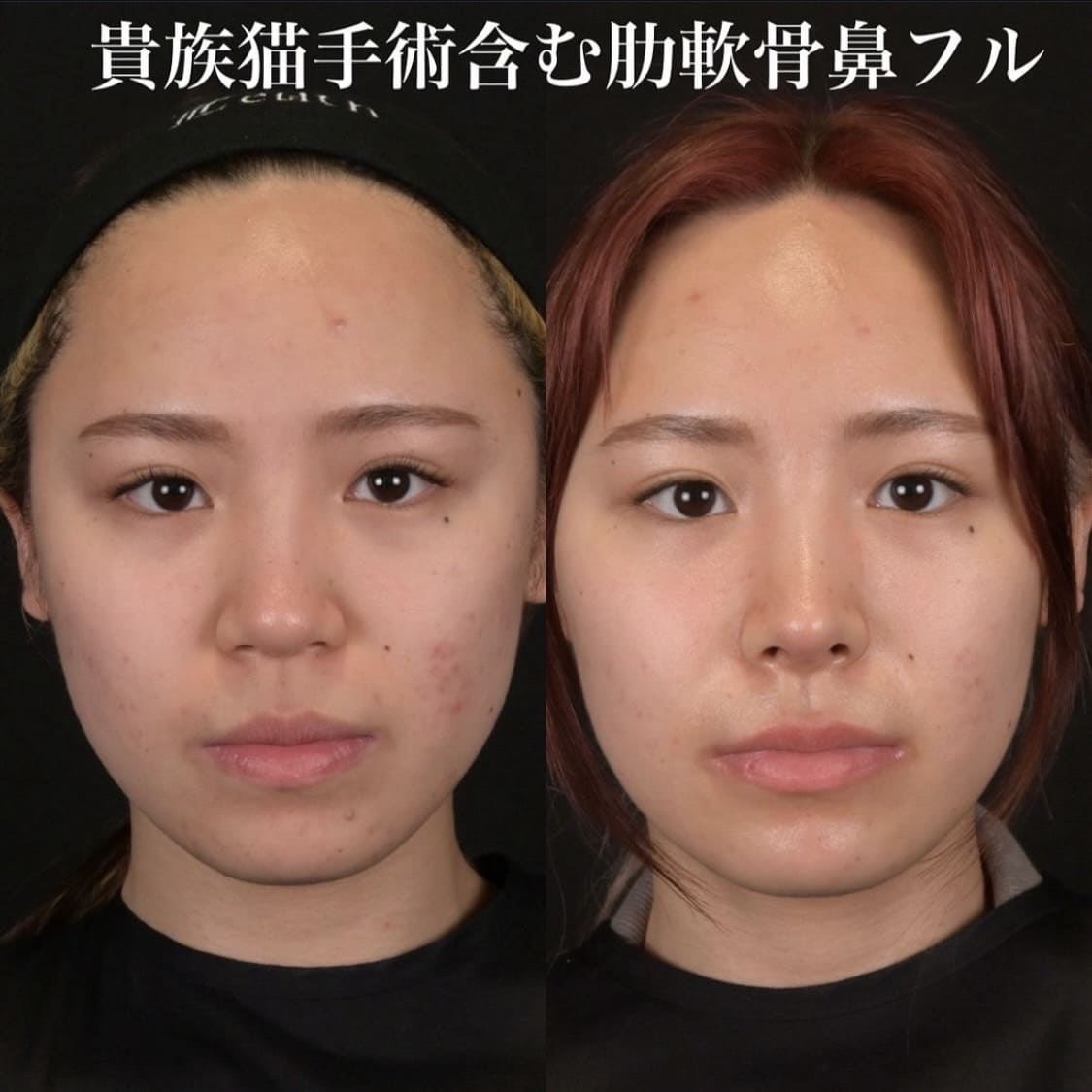 鉄医師による鼻整形の術前/術後1ヶ月