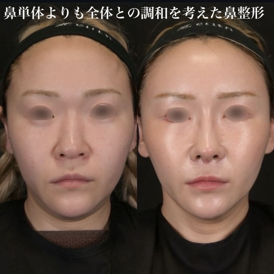 鉄医師による鼻整形の術前/術後２週間