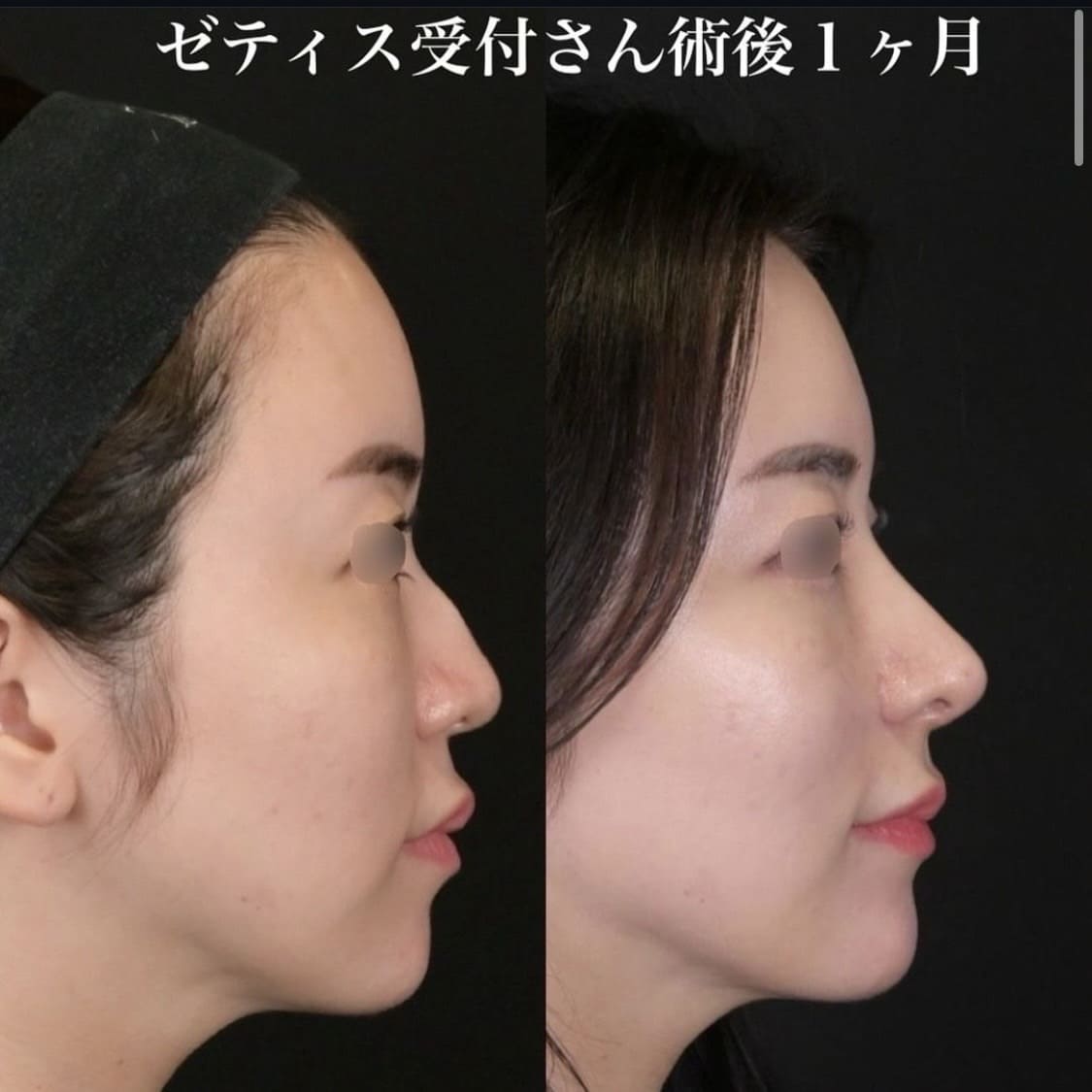鉄医師による鼻整形の術前/術後1ヶ月 بعد 
