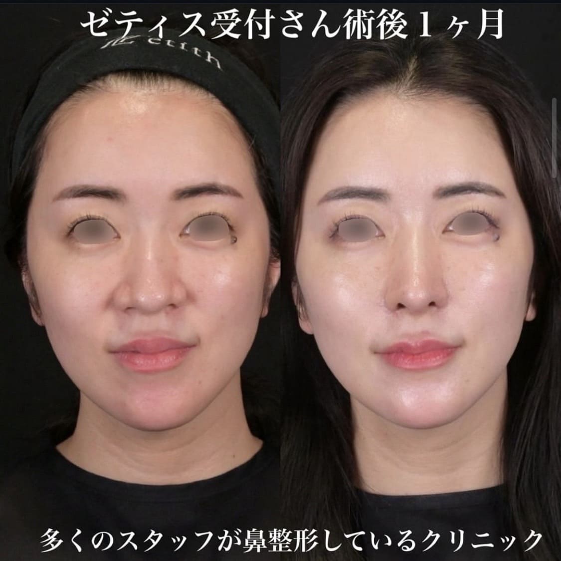 鉄医師による鼻整形の術前/術後1ヶ月