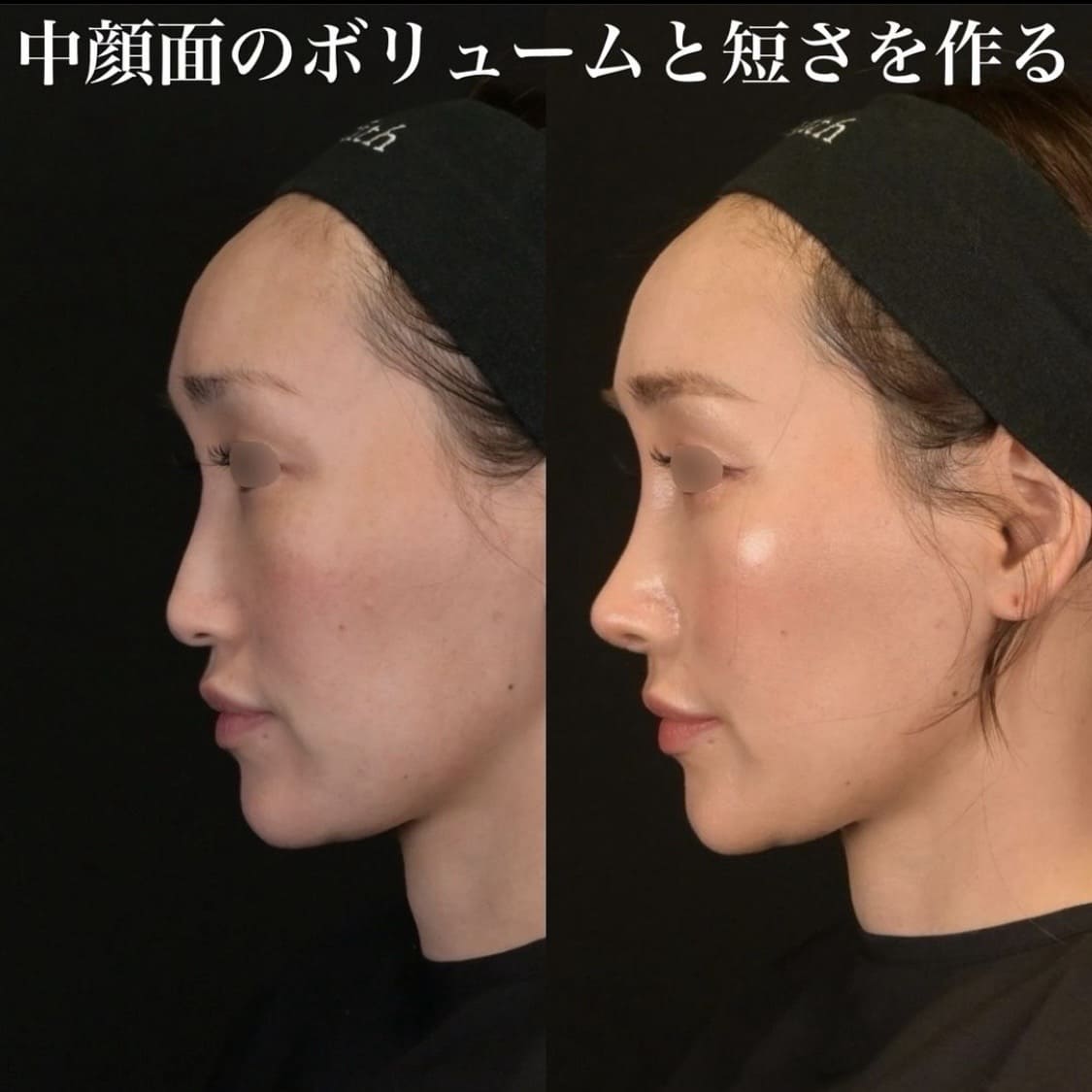 鉄医師による鼻整形の術前/術後1ヶ月 Дараа 