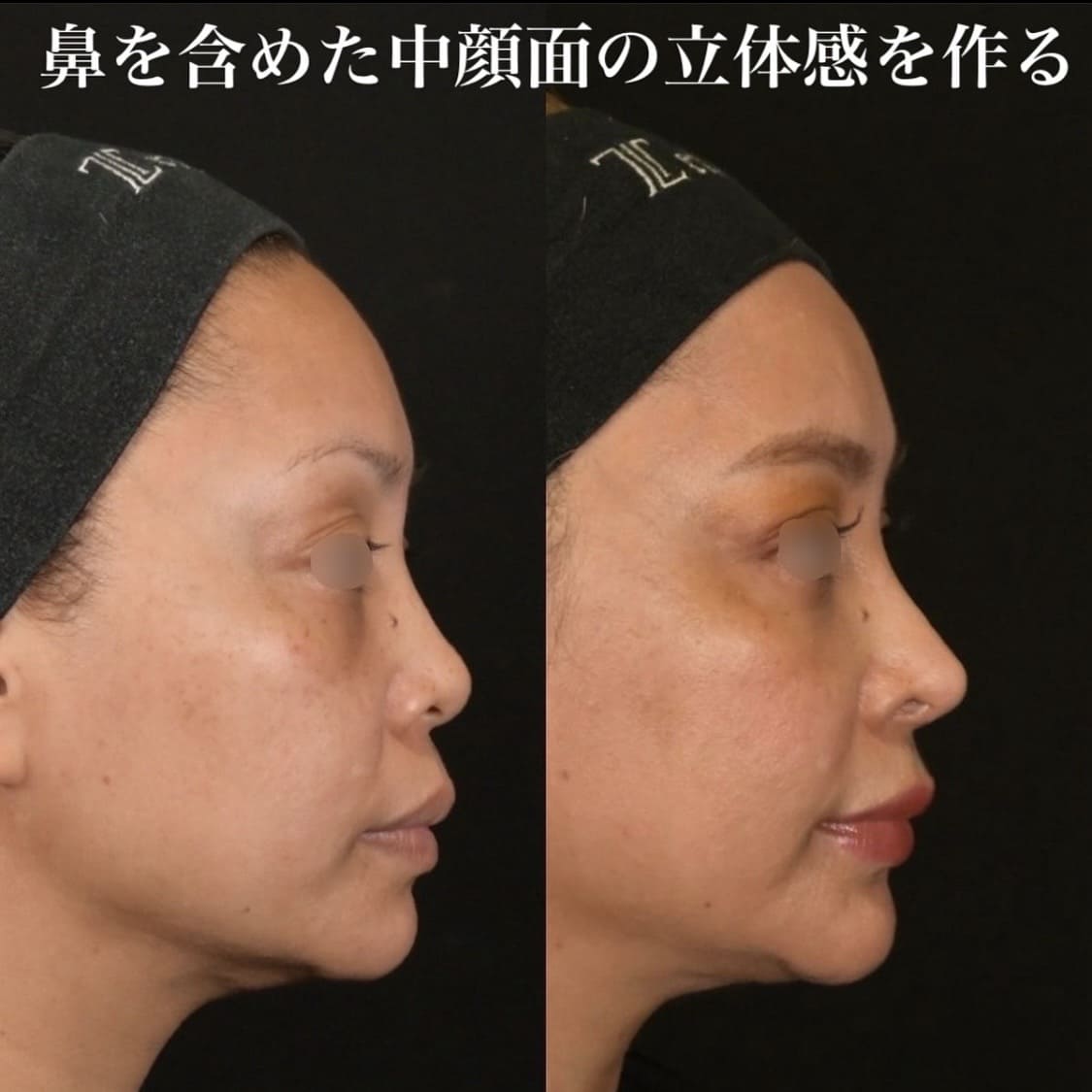 鉄医師による鼻整形の術前/術後6ヶ月 施術後 